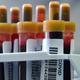 Blood samples to test for covid-19 antibodies sit on a table at a clinic in Moscow on May 15, 2020.